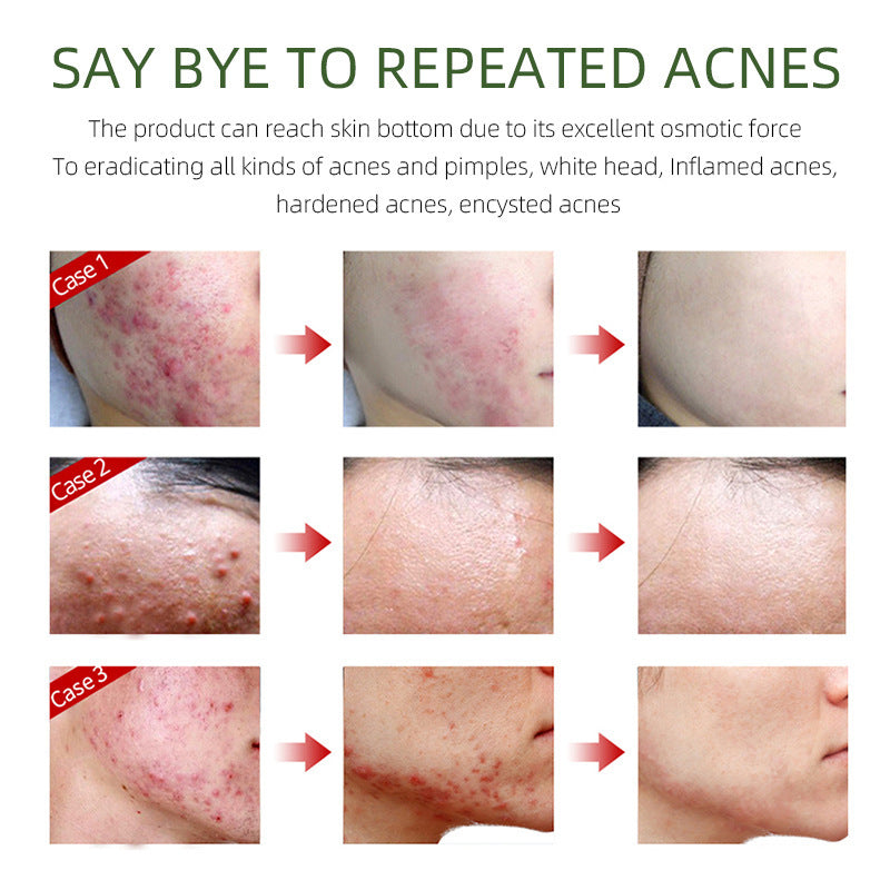 Herbal Acne Cream For Reducing Acne Marks Herbal Acne Cream For Reducing Acne Marks